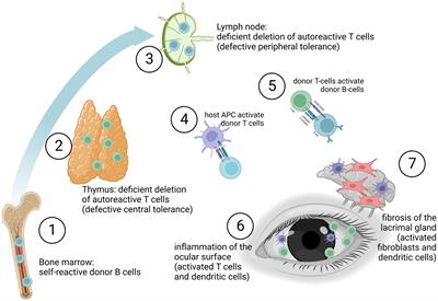 Challenges and concepts in the diagnosis and management of ocular graft-versus-host disease